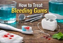 How to Treat Bleeding Gums 9 Honest Fixes That Finally Bring Relief