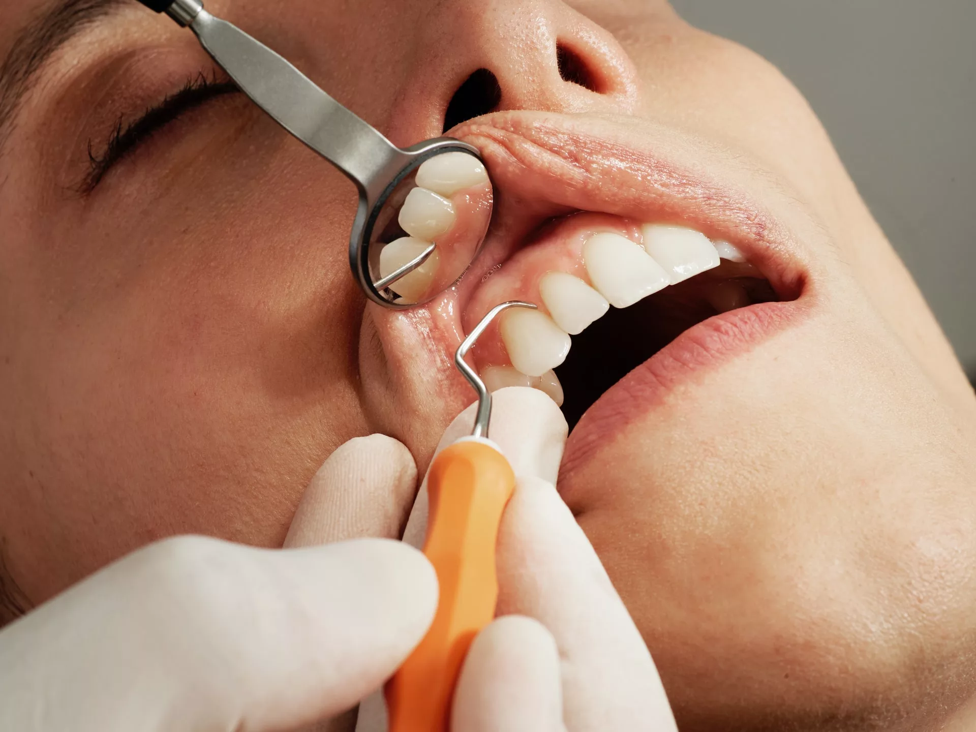 How to treat bleeding gums