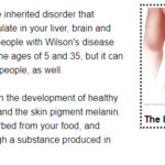 A Comprehensive Guide To Wilson Disease: Causes And Treatment