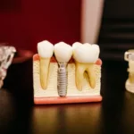 The Ultimate Guide To Dental Implants Cost: How Much Should You Expect To Pay?