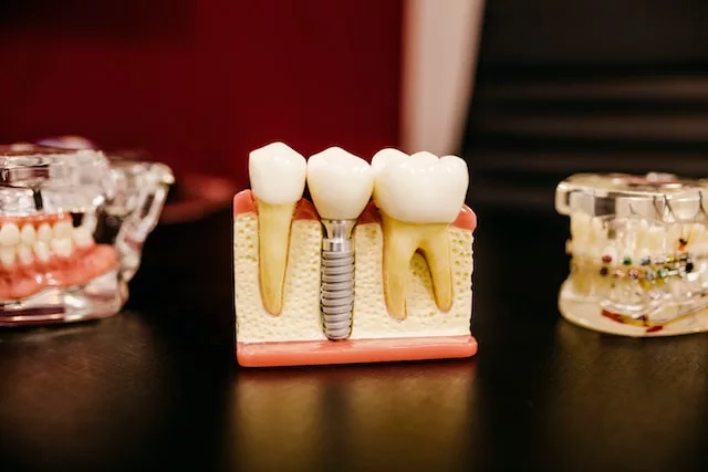 The ultimate guide to dental implants cost: how much should you expect to pay?