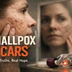 Smallpox Scars 9 Honest Truths That Bring Relief and Realistic Hope
