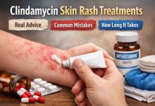 Clindamycin Skin Rash Treatments 9 Hard Truths That Bring Relief and a Few Frustrations