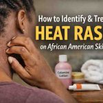 How to Identify and Treat Heat Rash on African American Skin 9 Hard Truths That Finally Bring Relief