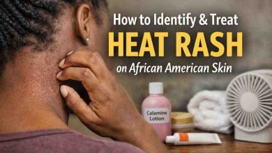 How to Identify and Treat Heat Rash on African American Skin 9 Hard Truths That Finally Bring Relief
