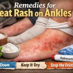 Remedies for Heat Rash on Ankles 11 Real World Fixes That Actually Bring Relief