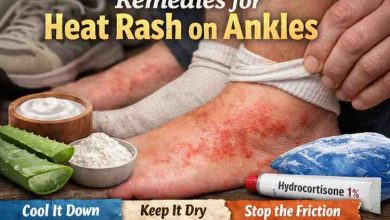 Remedies for Heat Rash on Ankles 11 Real World Fixes That Actually Bring Relief