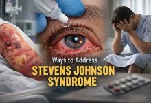 Ways to Address Steven Johnson Syndrome 9 Hard Lessons That Bring Real Relief