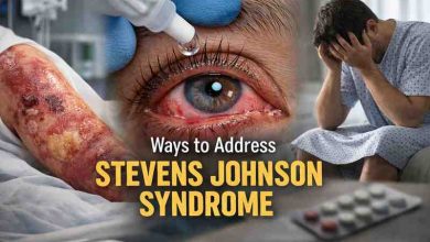 Ways to Address Steven Johnson Syndrome 9 Hard Lessons That Bring Real Relief