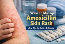 Ways to Manage Amoxicillin Skin Rash 9 Grounded Steps for Relief and Realistic Hope