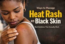 Ways to Manage Heat Rash on Black Skin 11 Grounded Fixes That Actually Bring Relief