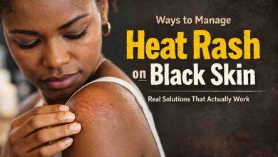 Ways to Manage Heat Rash on Black Skin 11 Grounded Fixes That Actually Bring Relief