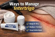 Ways to Manage Intertrigo 17 Grounded Strategies for Real Relief Without the Usual Frustration