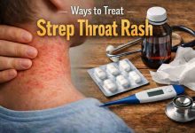 Ways to Treat Strep Throat Rash 11 Grounded Approaches That Actually Bring Relief