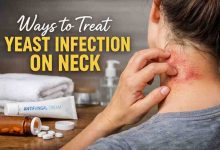 Ways to Treat Yeast Infection on Neck 11 Real Relief Strategies That Actually Work