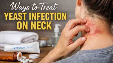 Ways to Treat Yeast Infection on Neck 11 Real Relief Strategies That Actually Work