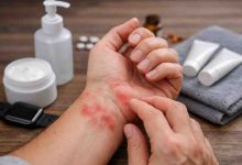 Red Blotches on Wrist 9 Real Patterns Ive Seen and What Actually Brings Relief