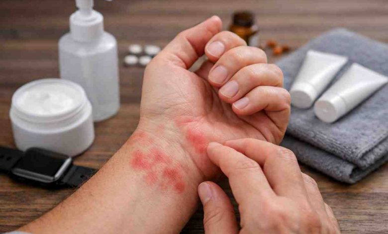 Red Blotches on Wrist 9 Real Patterns Ive Seen and What Actually Brings Relief