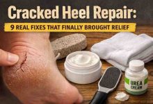 Cracked Heel Repair 9 Real Fixes That Finally Brought Relief After Months of Frustration