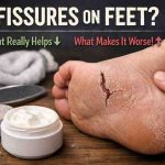 Fissures on Feet: 11 Hard Truths I’ve Seen Bring Relief (and Frustration) for Cracked Heels