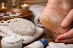 Pumice Stone For Cracked Heels 9 Hard Lessons People Learn Before They Finally See Relief 1
