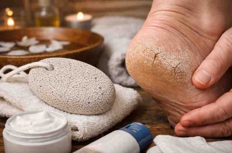 Pumice Stone For Cracked Heels 9 Hard Lessons People Learn Before They Finally See Relief 1