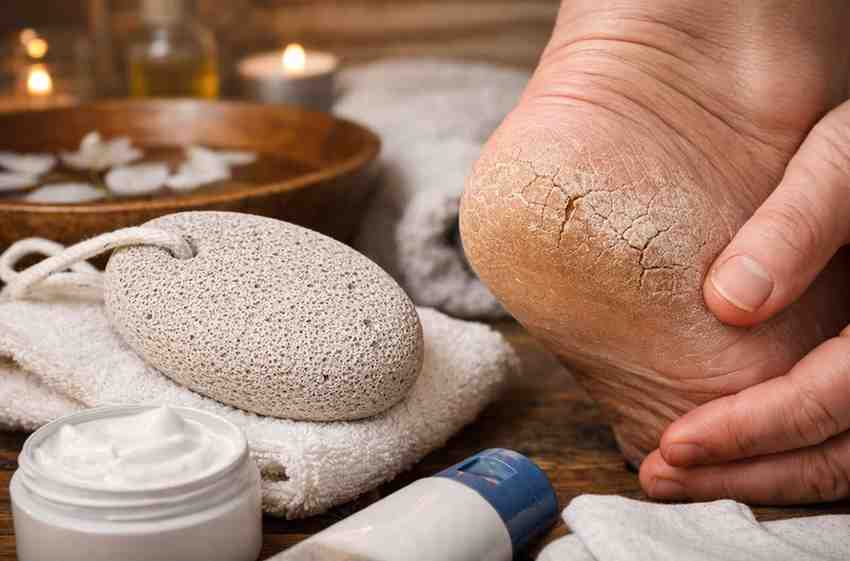 Pumice Stone For Cracked Heels 9 Hard Lessons People Learn Before They Finally See Relief 1