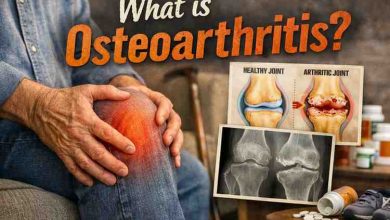 What is Osteoarthritis 9 Hard Truths That Finally Bring Relief Most People Learn Too Late