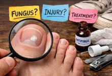 White Marks on Toenails 9 Real Causes Frustration What Actually Brings Relief