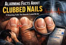 Alarming Facts About Clubbed Nails 17 Disturbing Truths That Honestly Freaked Me Out