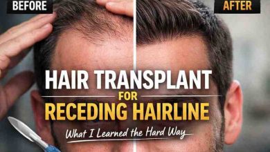 Hair Transplant for Receding Hairline: 7 Honest Things I Learned the Hard Way