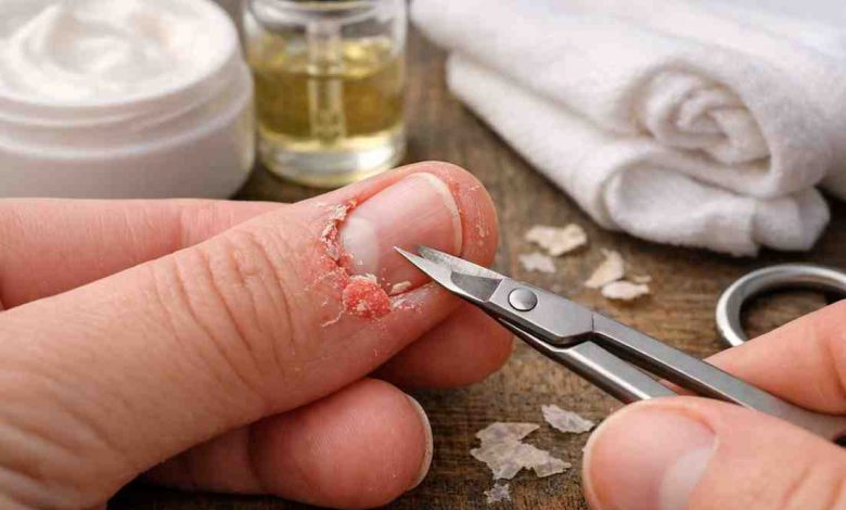 Broken Skin Around Nails 9 Frustrating Causes Ive Seen and What Actually Helps