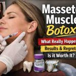 Masseter muscle botox 7 hard truths real relief and one warning I wish Id heard sooner