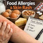 Food Allergies Skin Rash 9 Frustrating Patterns Ive Watched People Miss Before Finally Finding Relief 1