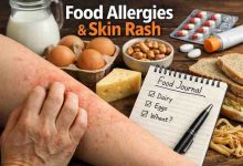 food allergies skin rash 9 frustrating patterns ive watched people miss before finally finding relief