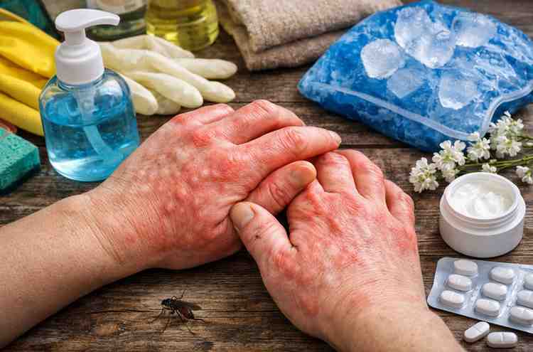Hands Are Itching And Swelling 11 Real Causes Most People Miss And The Relief That Finally Works 1