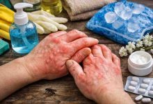 hands are itching and swelling 11 real causes most people miss and the relief that finally works