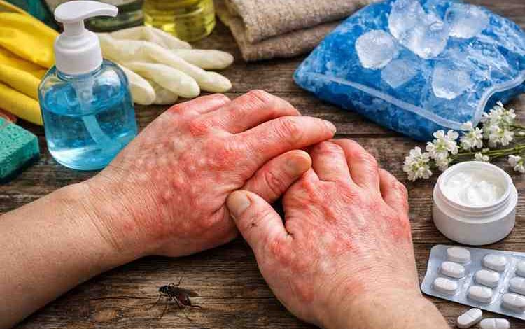 hands are itching and swelling 11 real causes most people miss and the relief that finally works