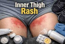 inner thigh rash 11 frustrating truths people discover too late and what actually brings relief