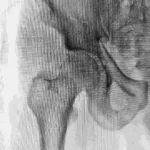 Chronic Recurrent Multifocal Osteomyelitis