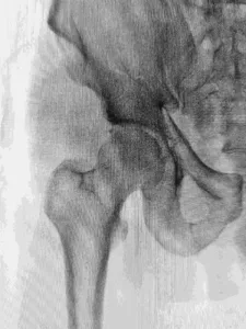 Chronic Recurrent Multifocal Osteomyelitis